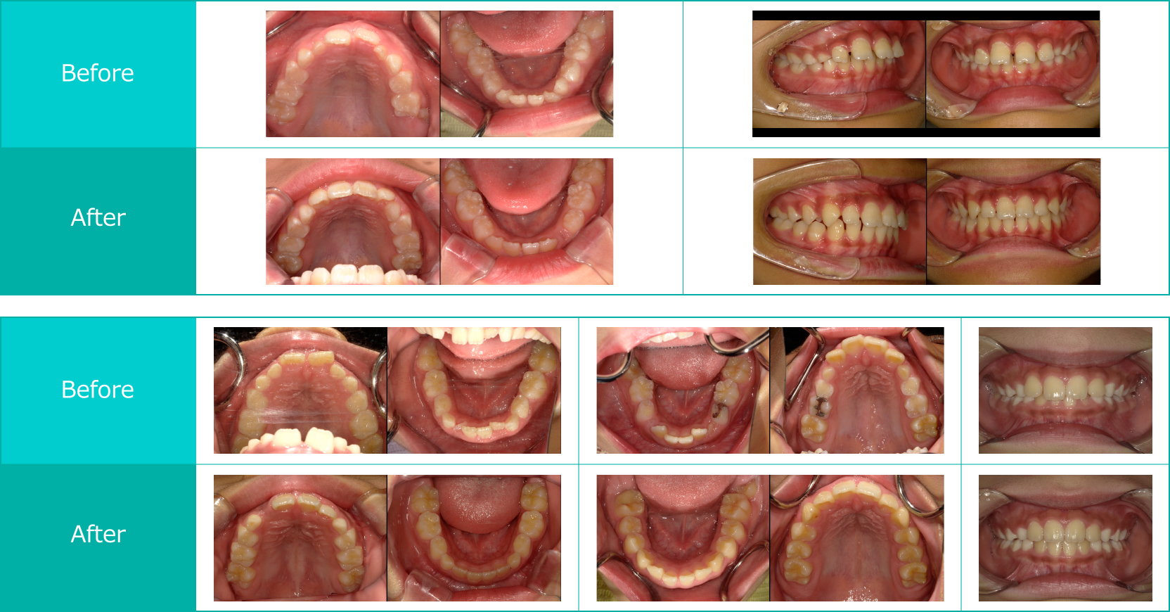 施術前と施術後の比較口内写真