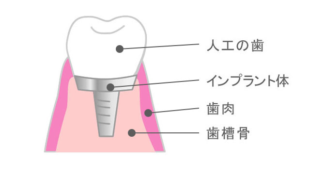 インプラントイメージ